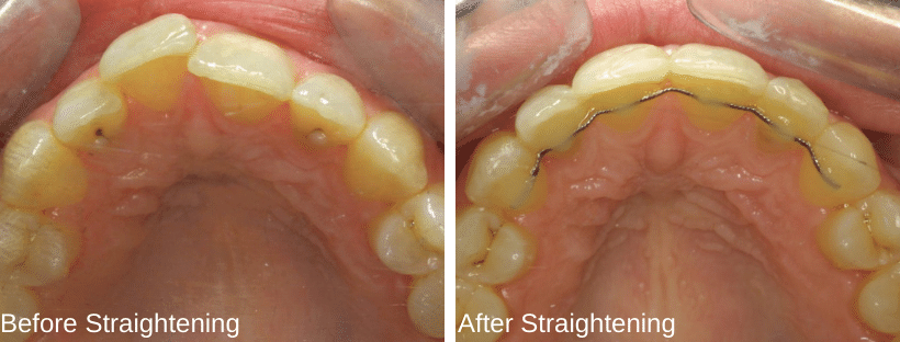 before and after straight teeth treatment