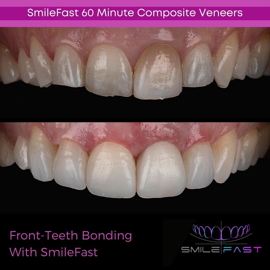 SmileFast Composite Veneers