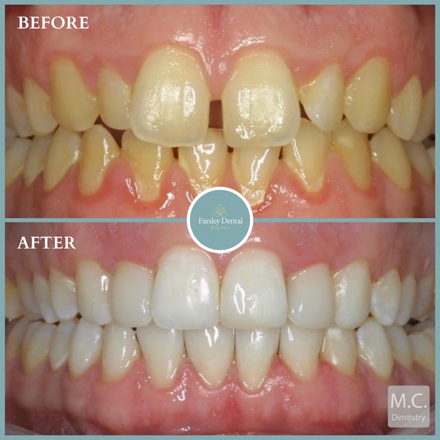 Composite Bonding + Tooth Whitening